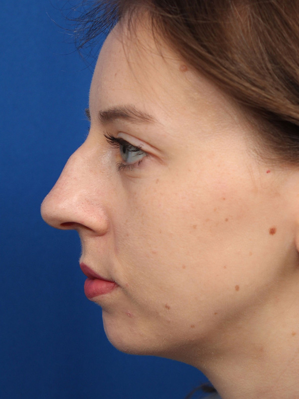 Female Cosmetic Rhinoplasty