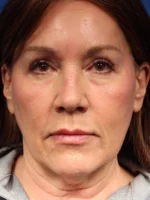 Necklift