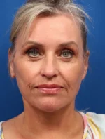 Vertical Vector Facelift
