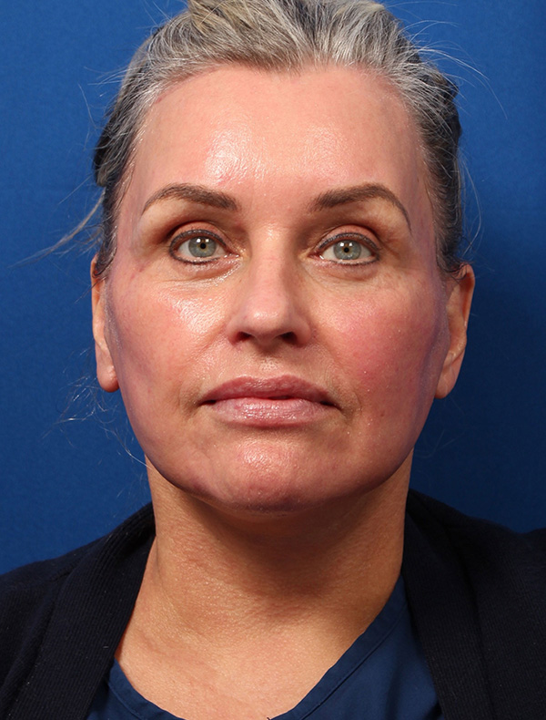 Vertical Vector Facelift