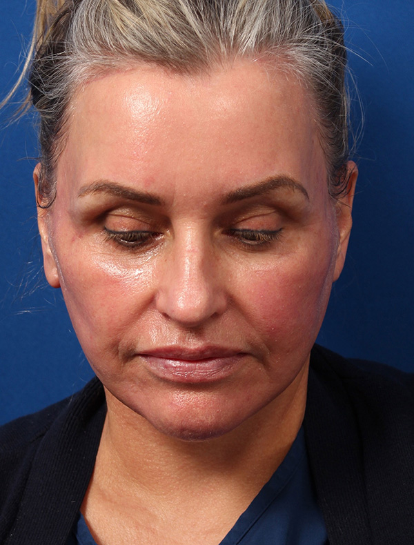 Vertical Vector Facelift
