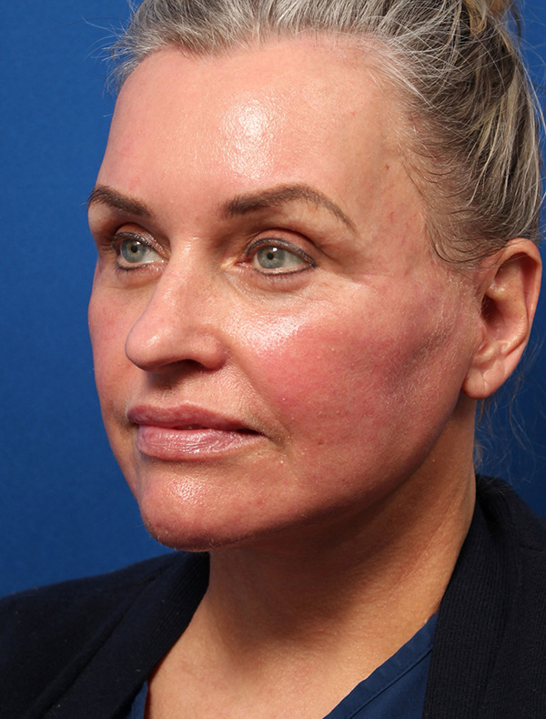 Vertical Vector Facelift