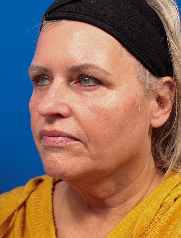 Vertical Vector Facelift