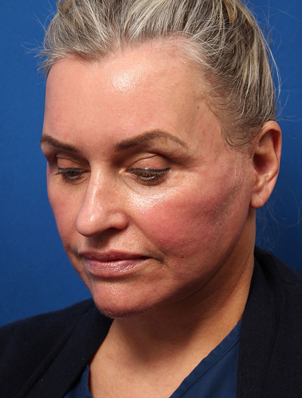 Vertical Vector Facelift
