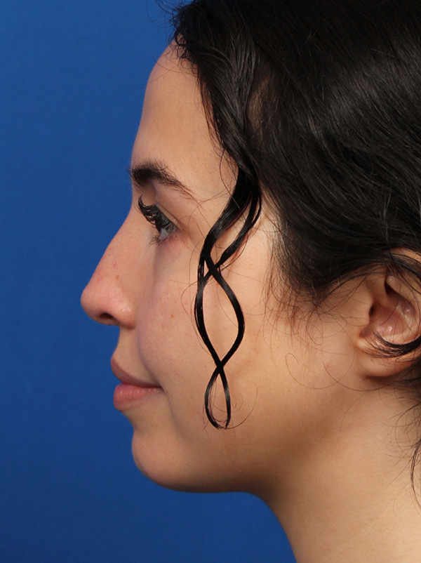 Facial Implants