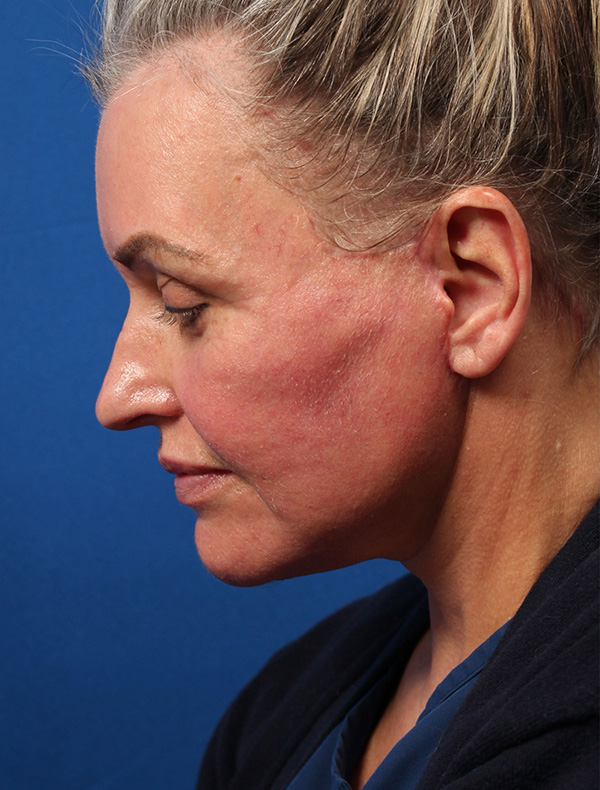 Vertical Vector Facelift
