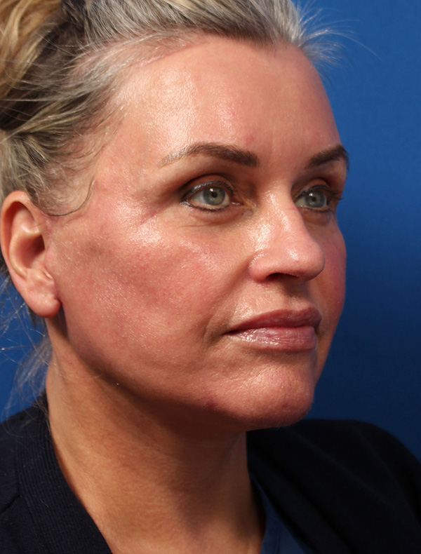 Vertical Vector Facelift