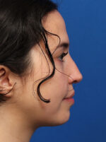 Facial Implants