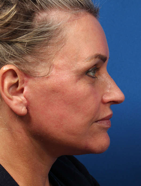 Vertical Vector Facelift
