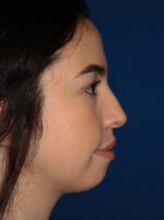 Facial Implants