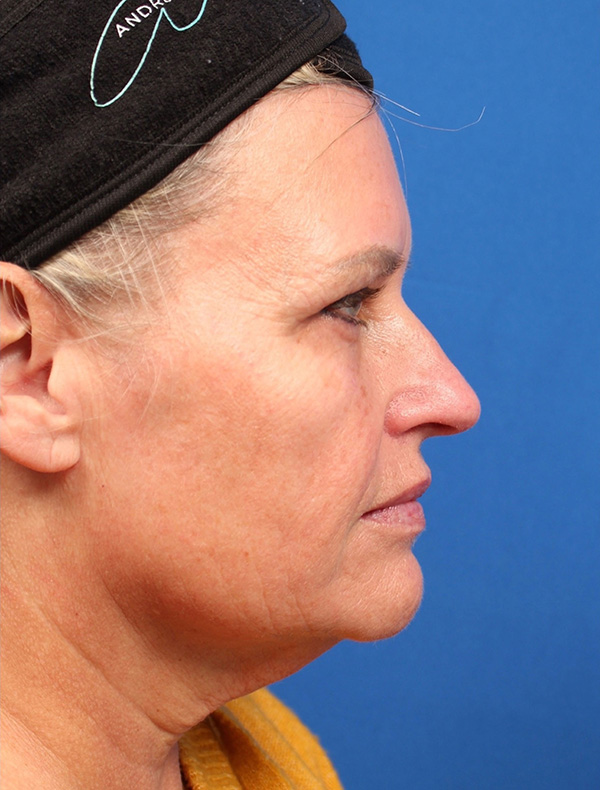 Vertical Vector Facelift