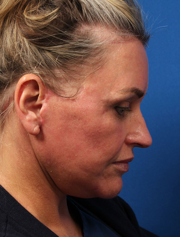 Vertical Vector Facelift