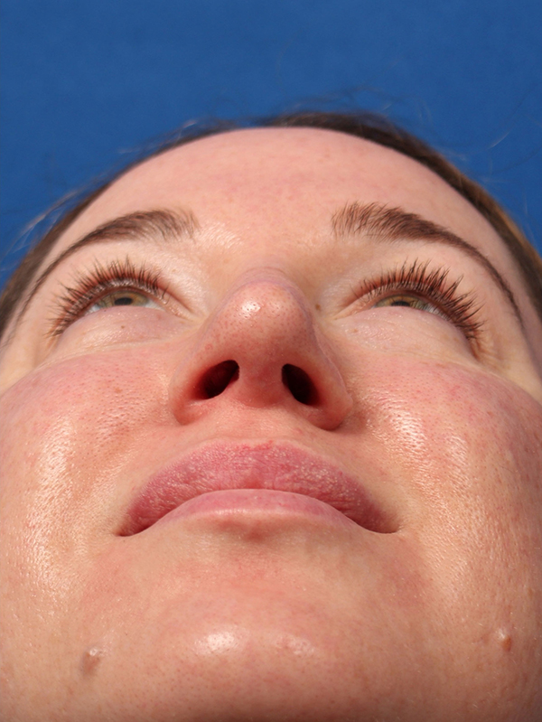 Female Cosmetic Rhinoplasty