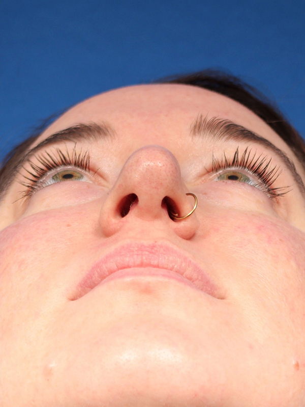 Female Cosmetic Rhinoplasty