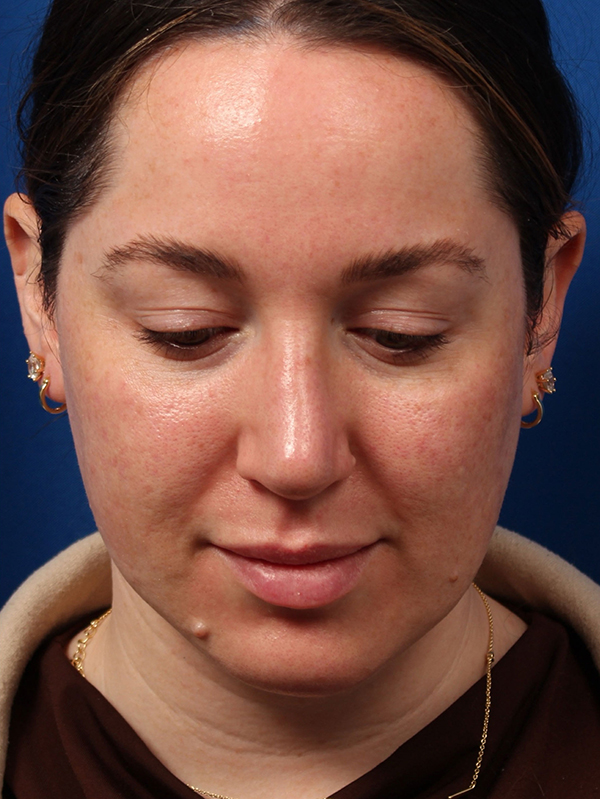 Female Cosmetic Rhinoplasty