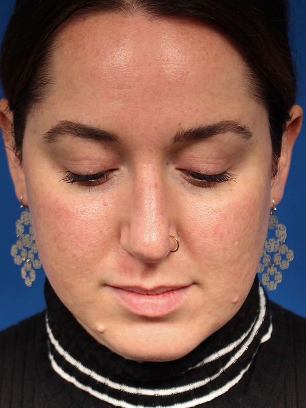 Female Cosmetic Rhinoplasty