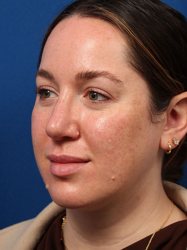 Female Cosmetic Rhinoplasty