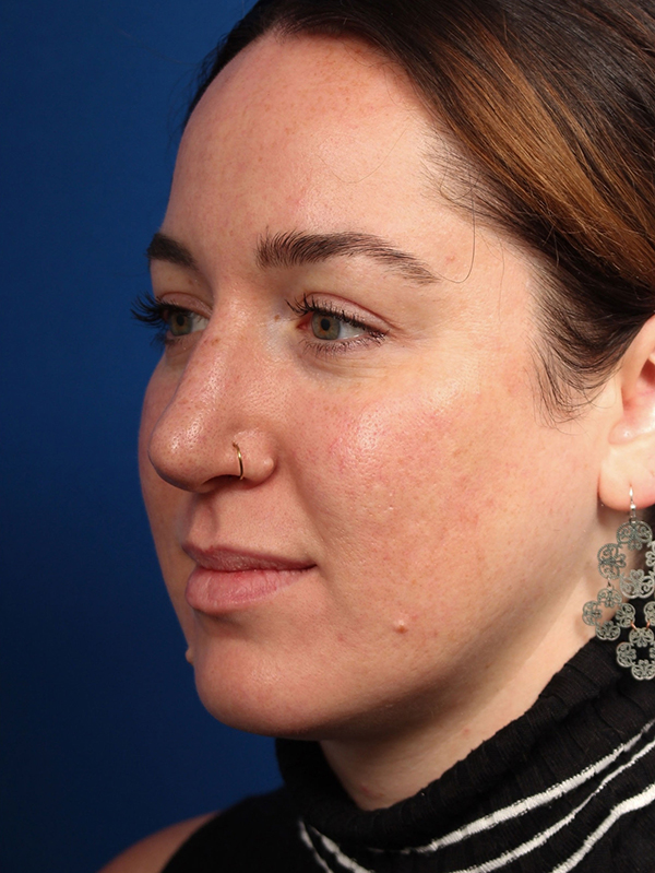 Female Cosmetic Rhinoplasty