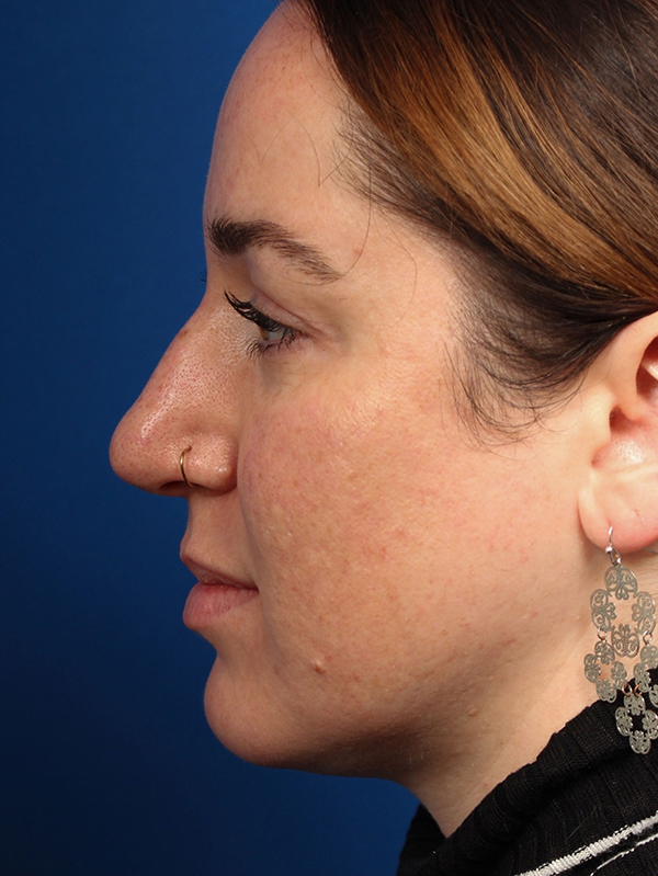 Female Cosmetic Rhinoplasty