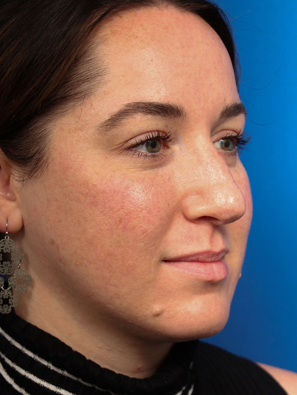 Female Cosmetic Rhinoplasty