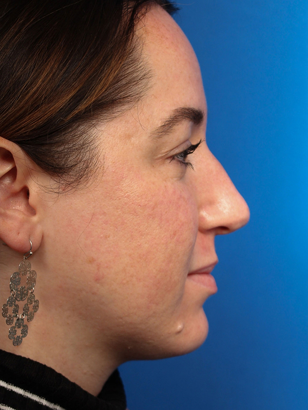 Female Cosmetic Rhinoplasty