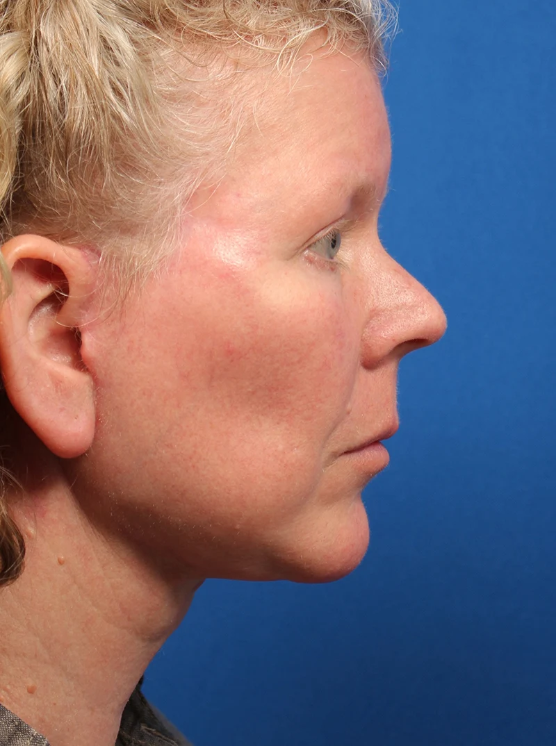 Vertical Vector Facelift