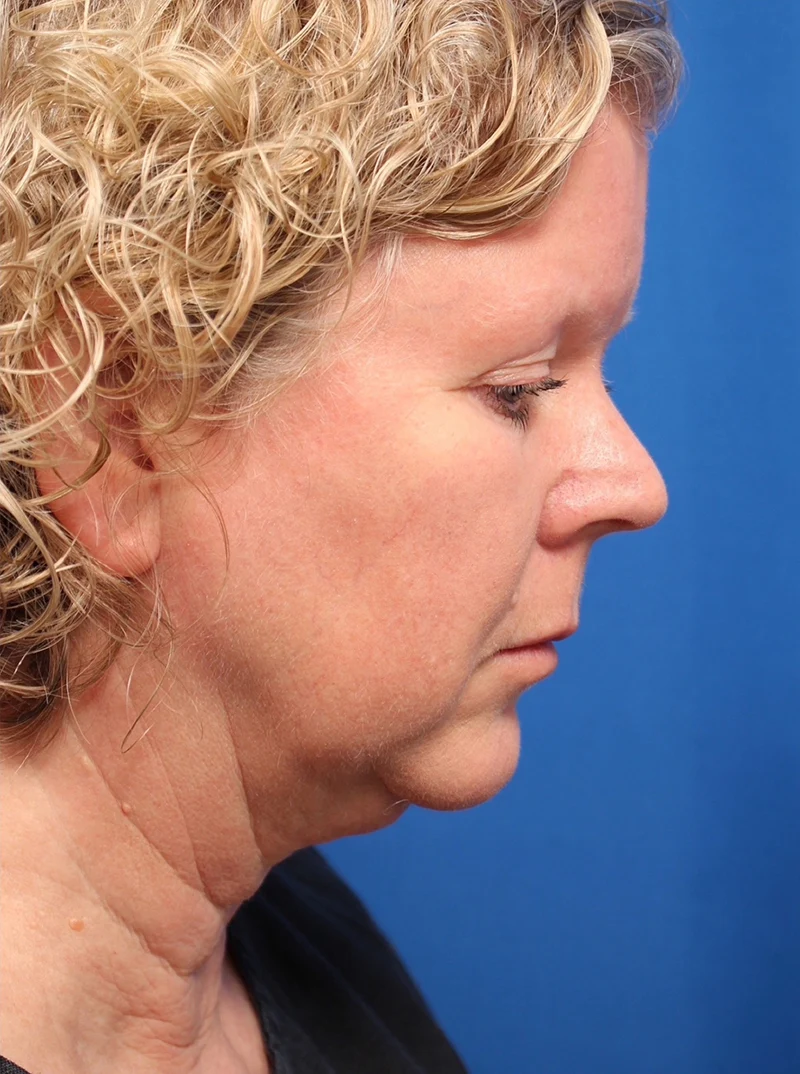 Vertical Vector Facelift