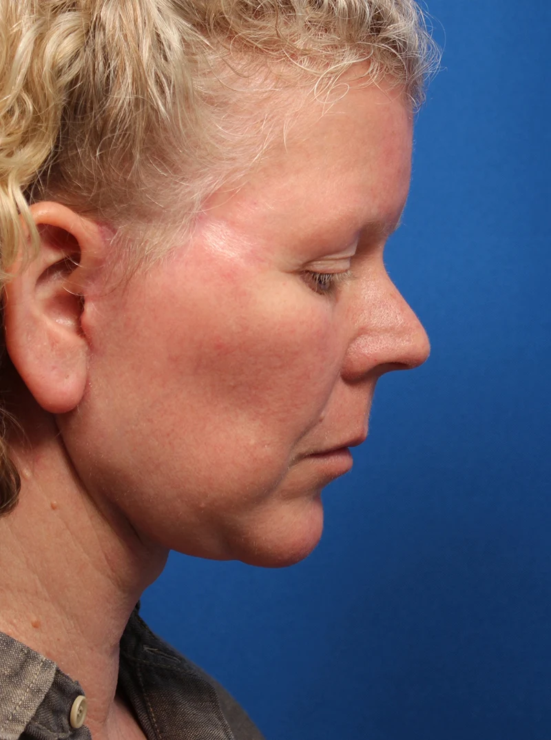 Vertical Vector Facelift