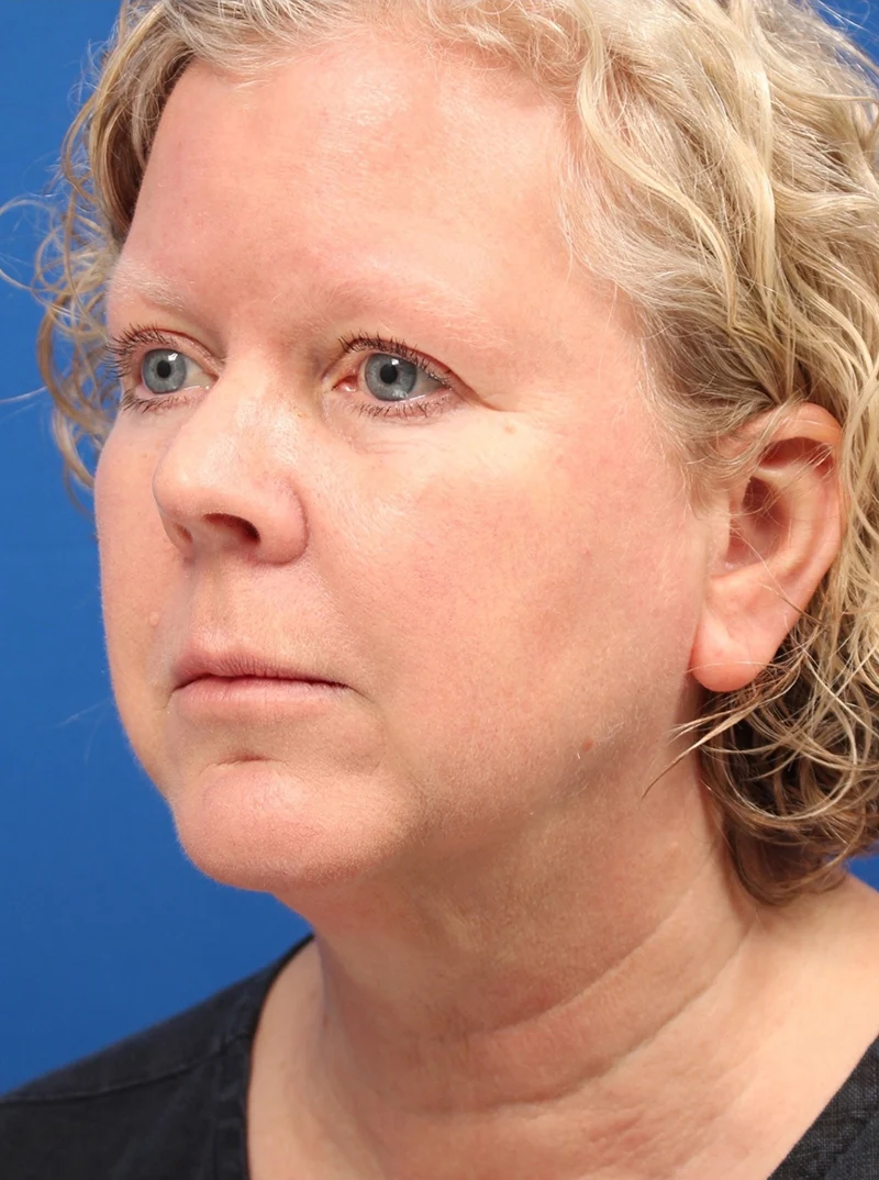 Vertical Vector Facelift