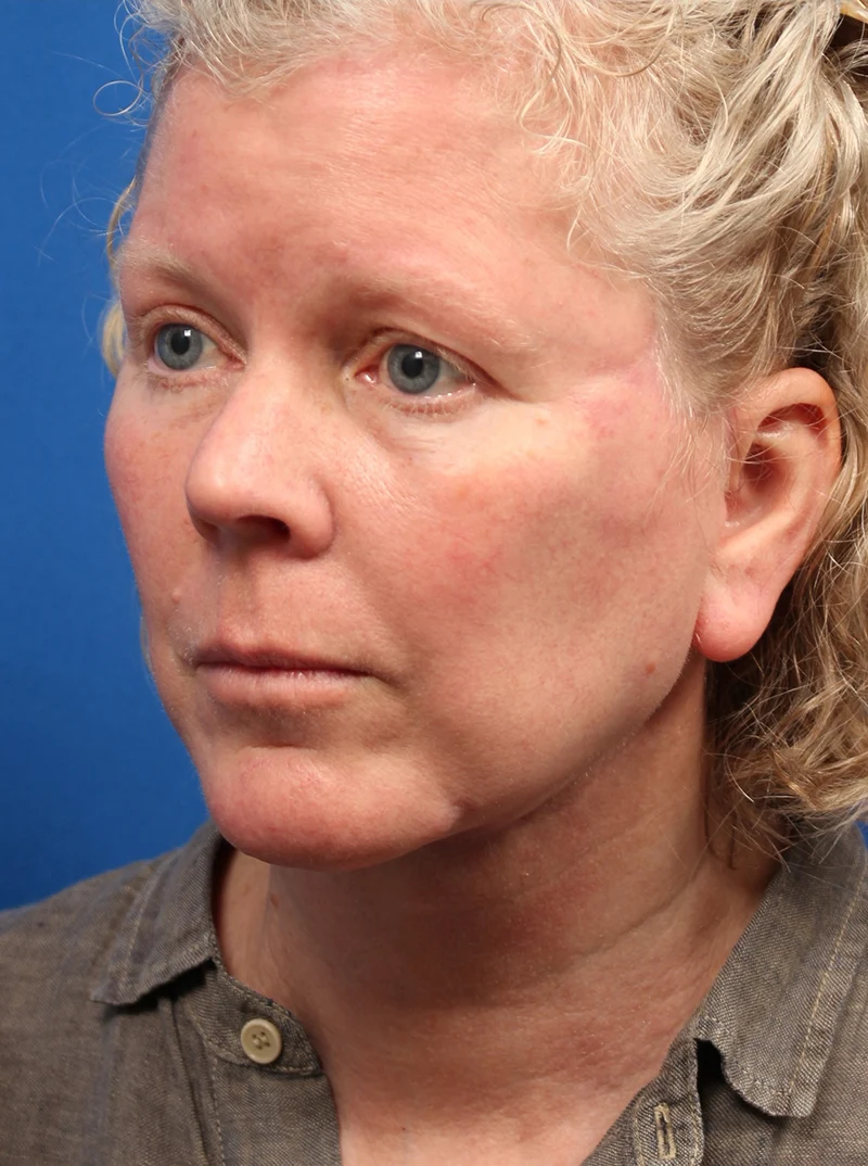 Vertical Vector Facelift