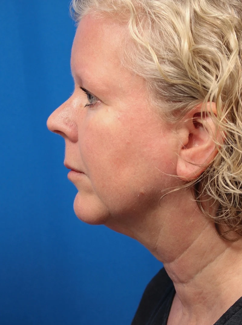 Vertical Vector Facelift