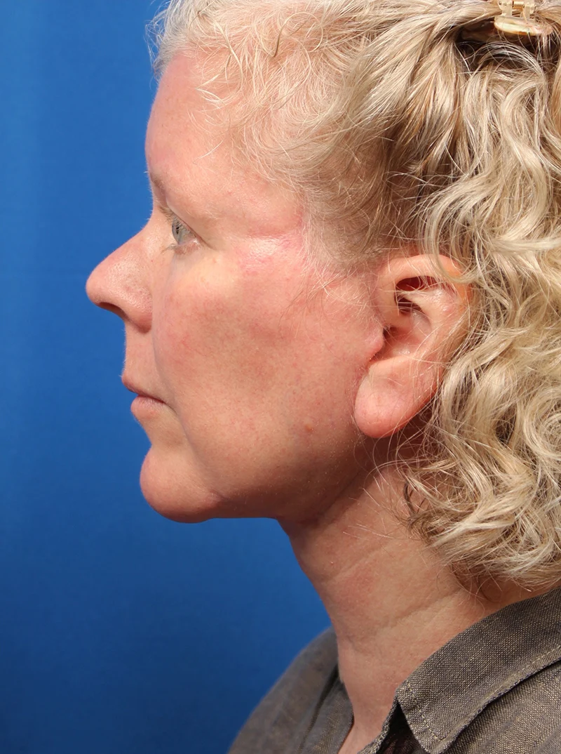 Vertical Vector Facelift