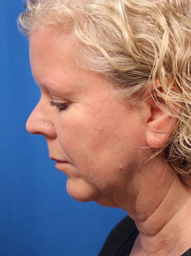 Vertical Vector Facelift