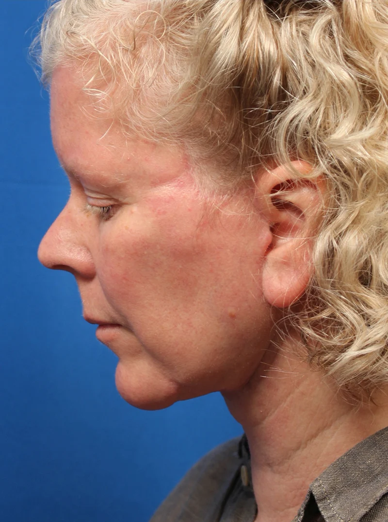 Vertical Vector Facelift