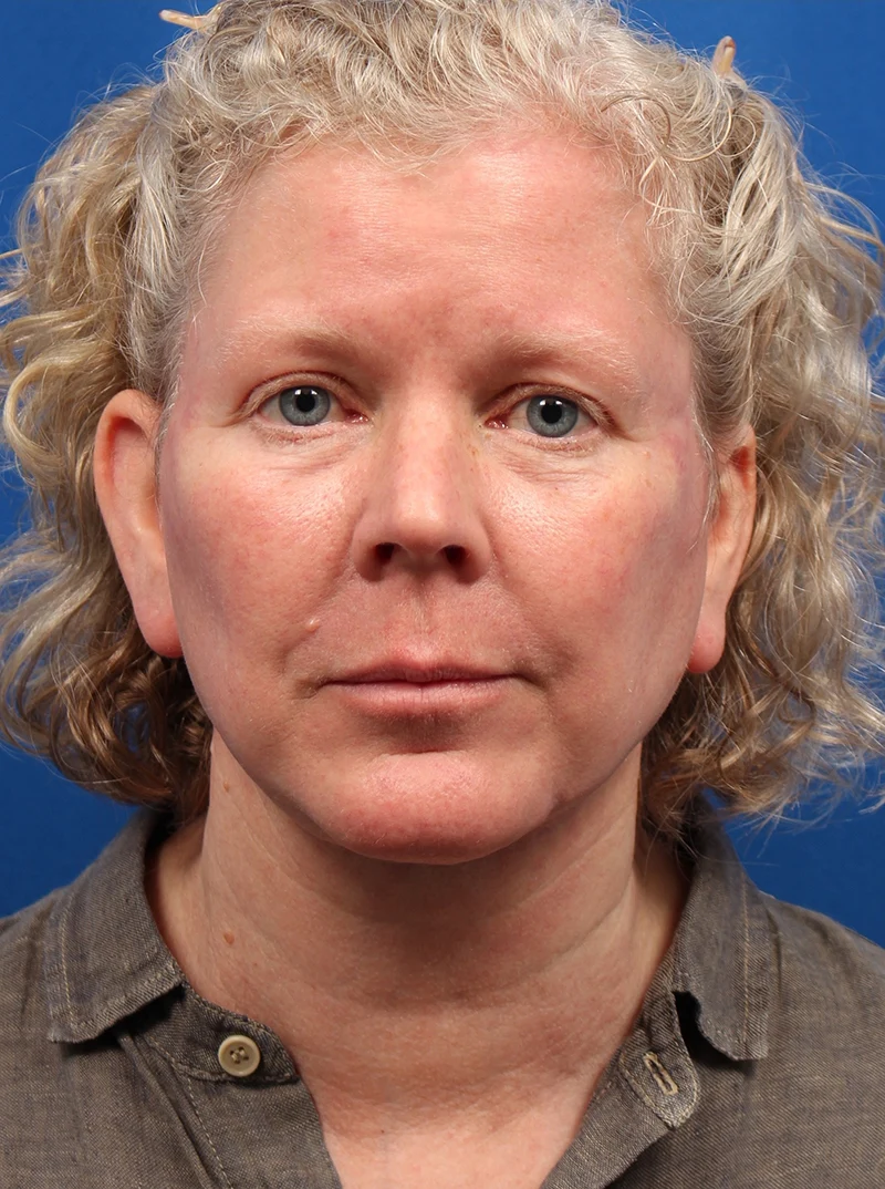 Vertical Vector Facelift