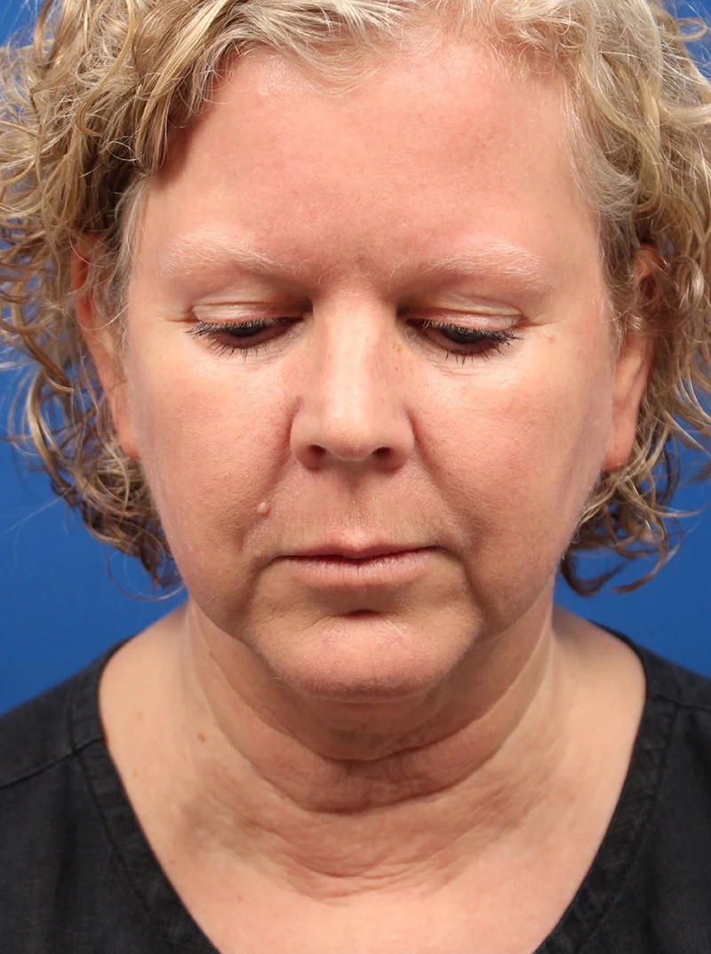 Vertical Vector Facelift