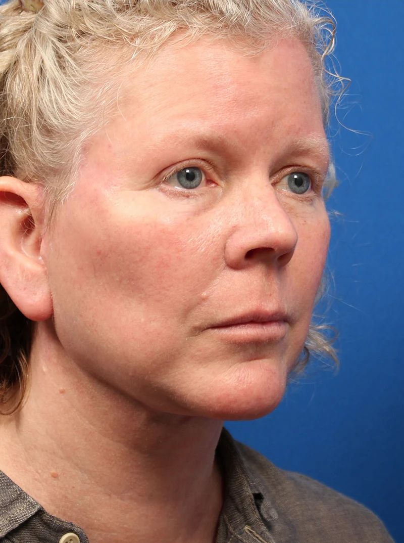 Vertical Vector Facelift