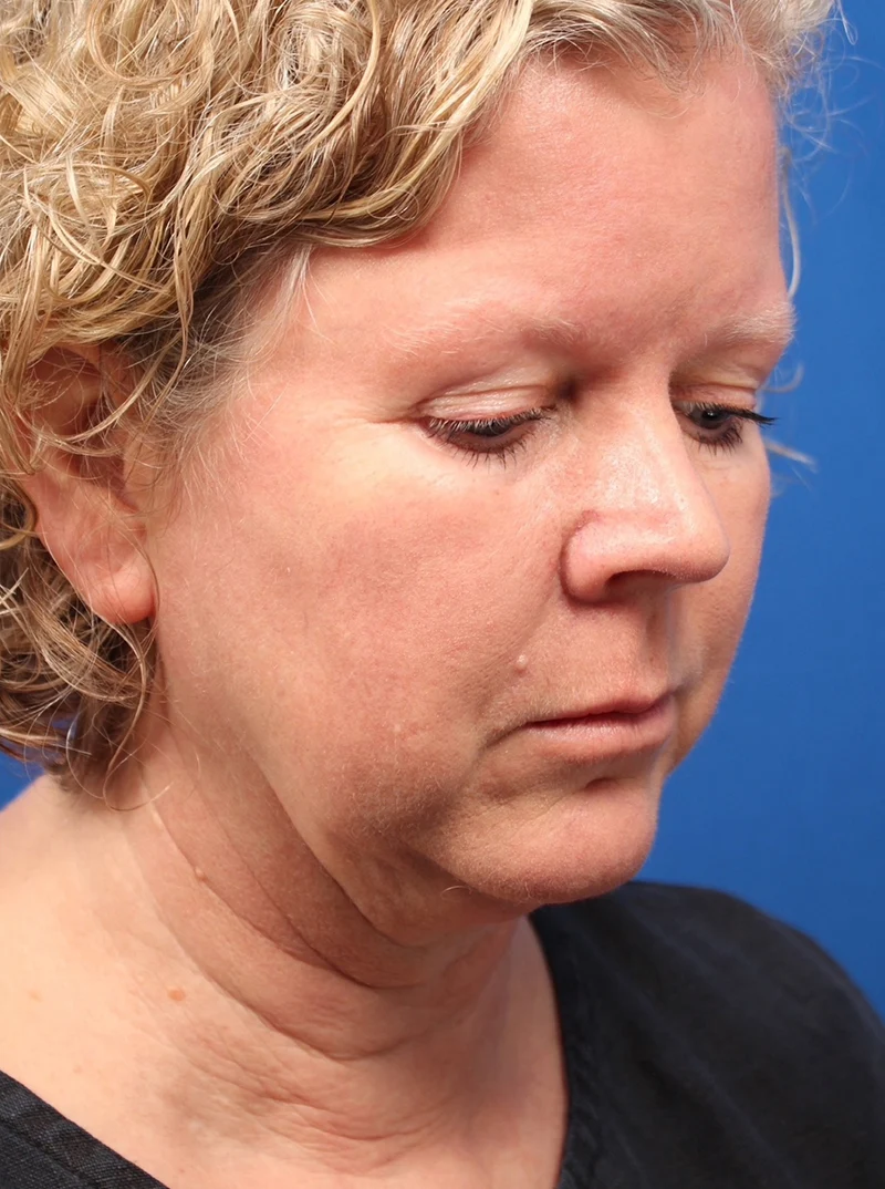 Vertical Vector Facelift