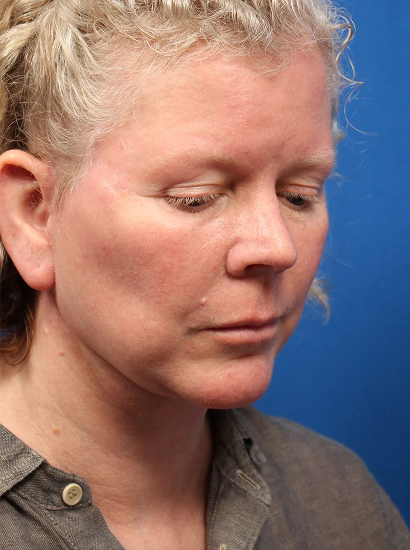 Vertical Vector Facelift