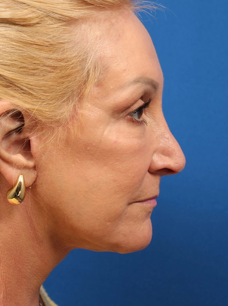 Vertical Vector Facelift