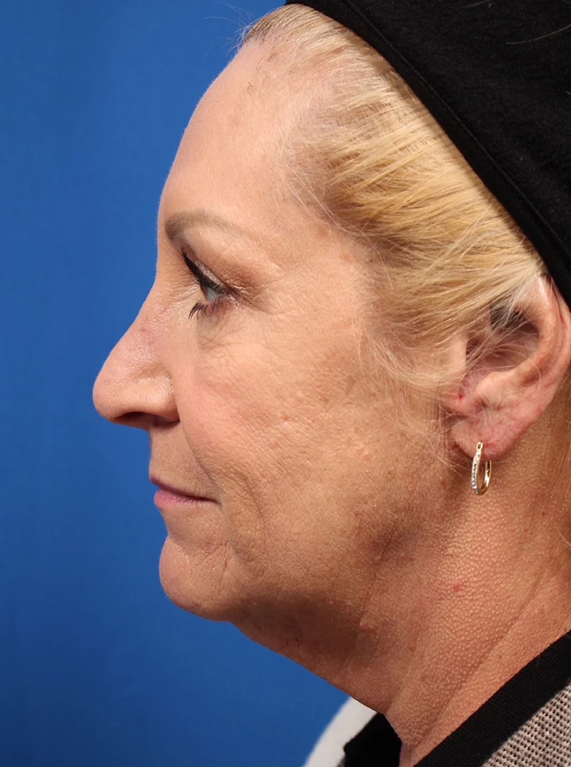 Vertical Vector Facelift