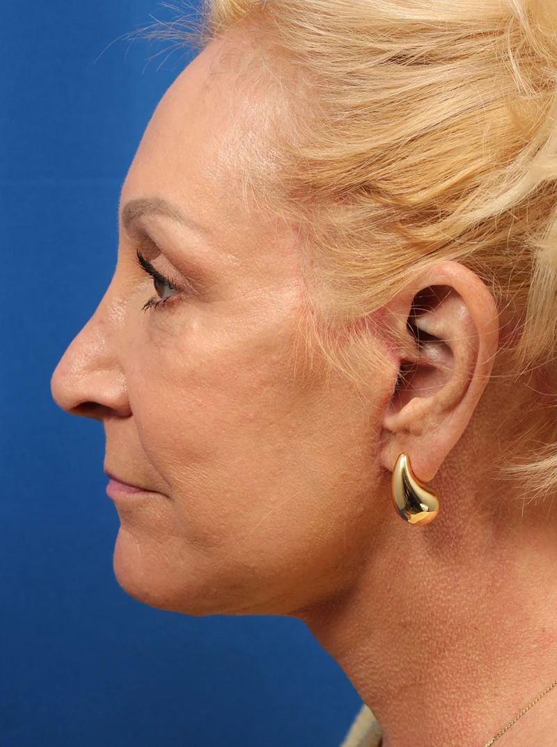 Vertical Vector Facelift