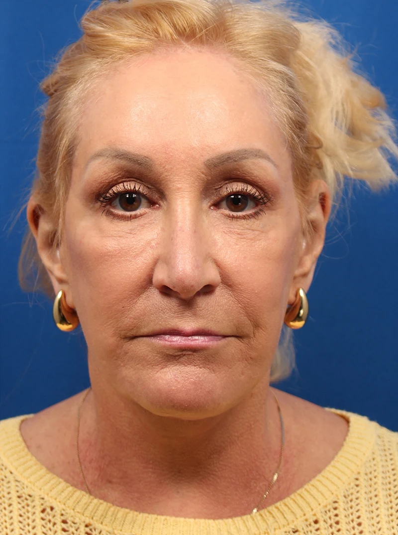 Vertical Vector Facelift