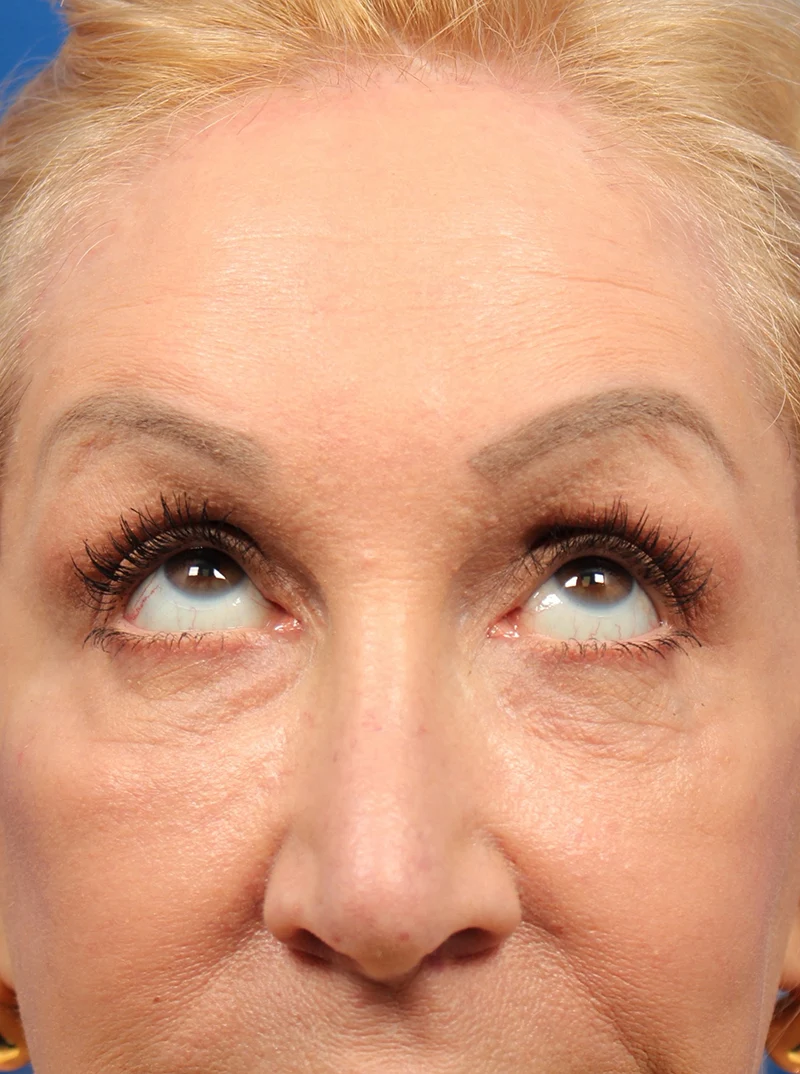 Vertical Vector Facelift