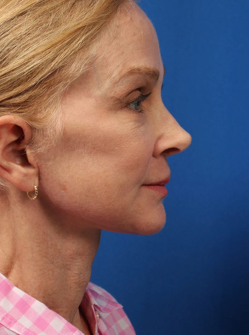 Vertical Vector Facelift