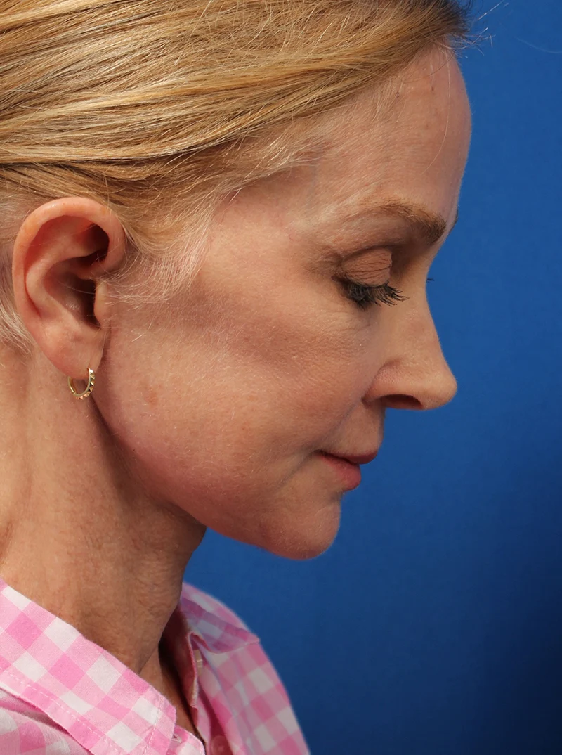 Vertical Vector Facelift