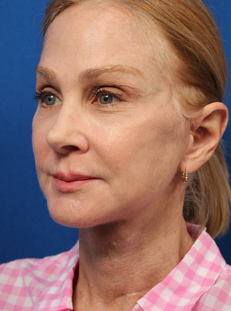 Vertical Vector Facelift