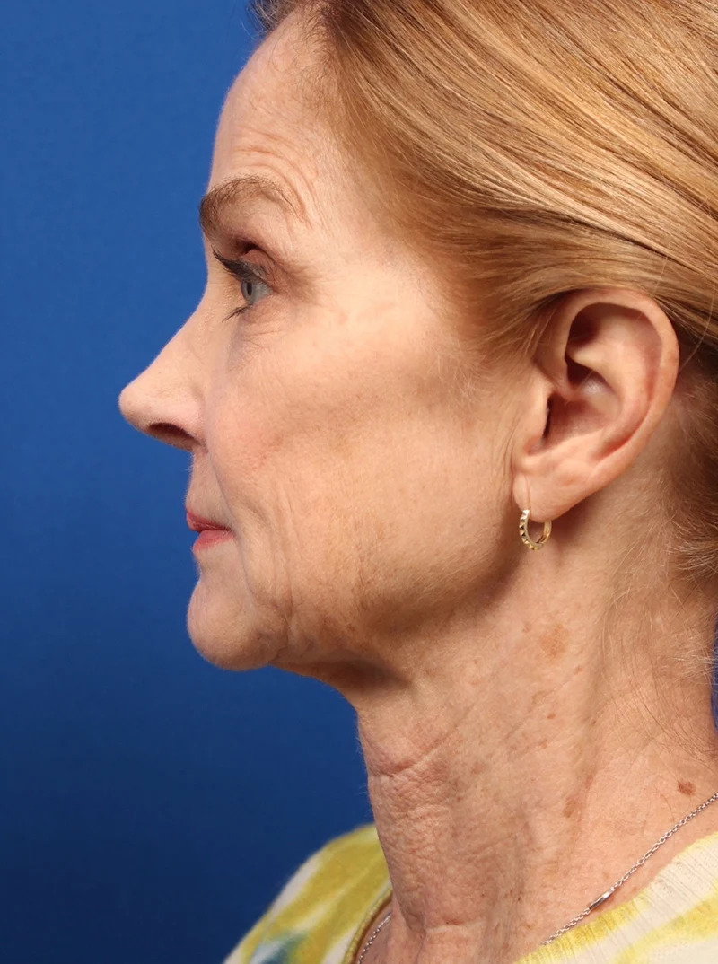 Vertical Vector Facelift