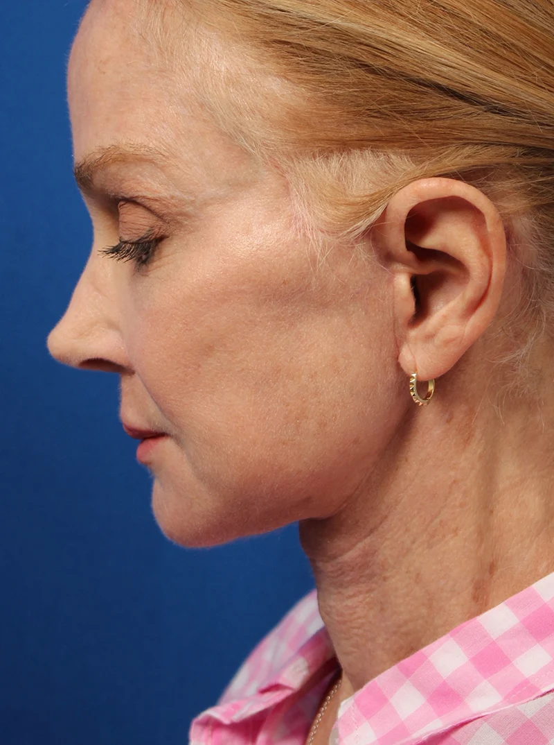Vertical Vector Facelift