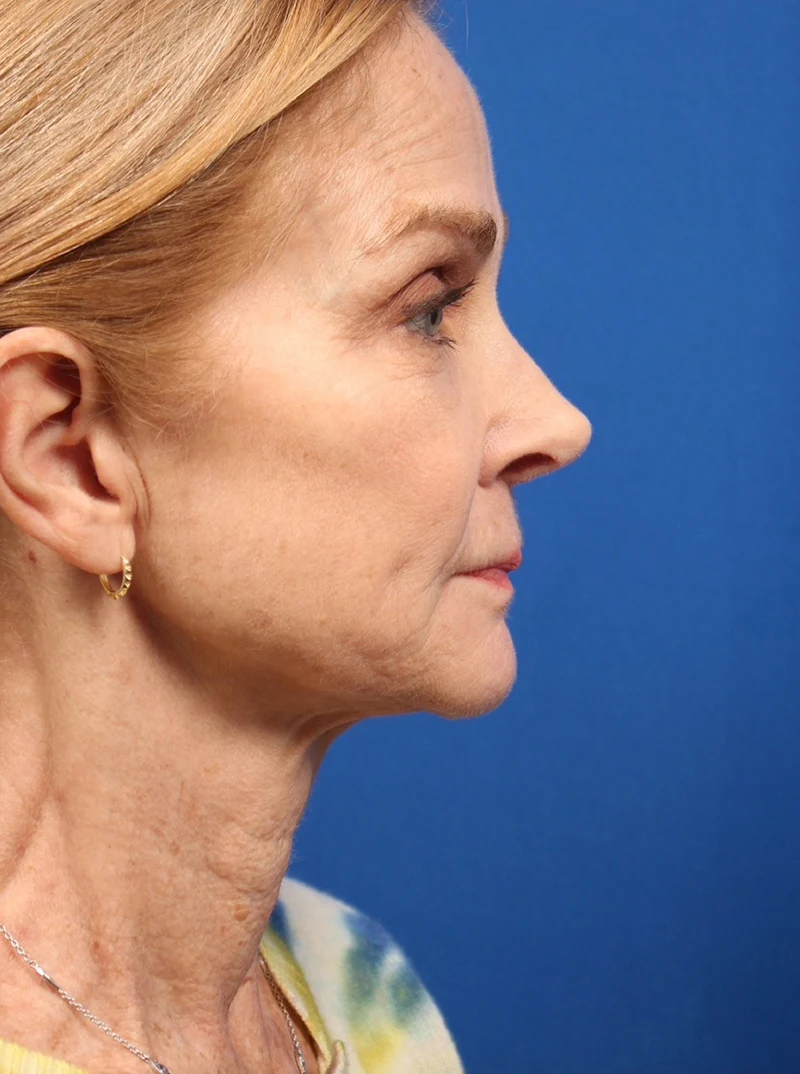 Vertical Vector Facelift